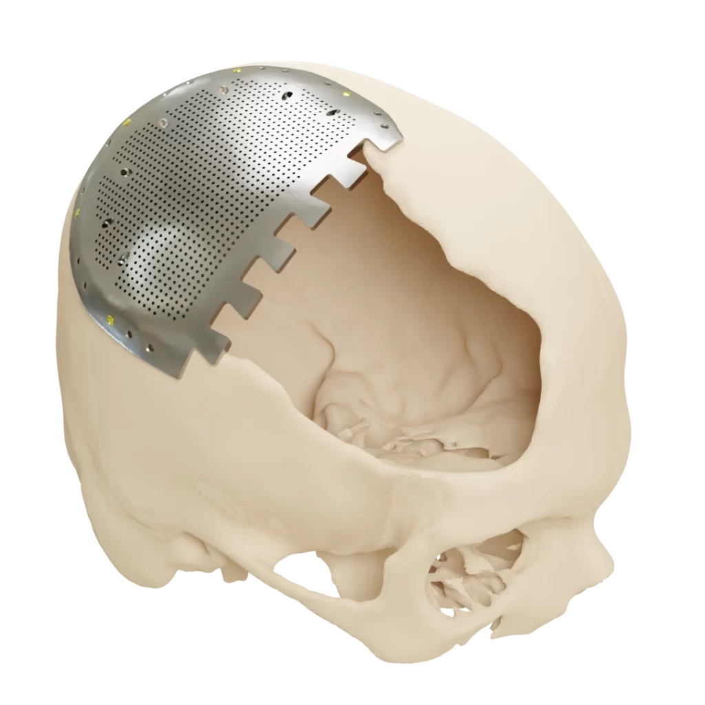 Patient Specific Cranial Implant with modular design