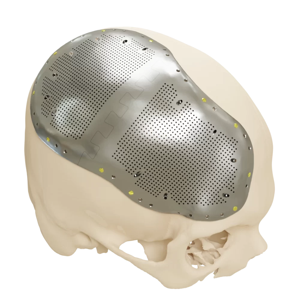 Patient Specific Cranial Implant
