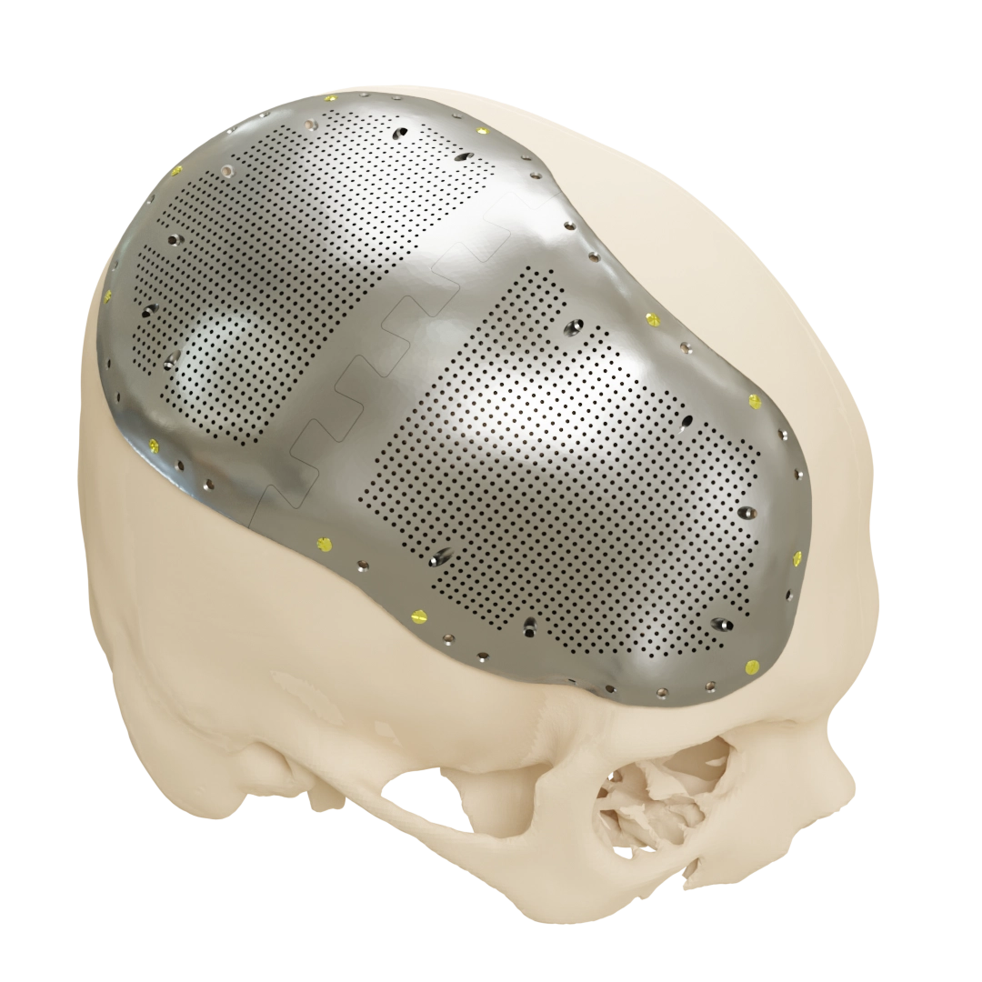Patient Specific Cranial Implant
