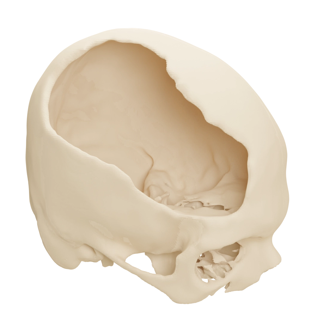 Large Cranial Defect