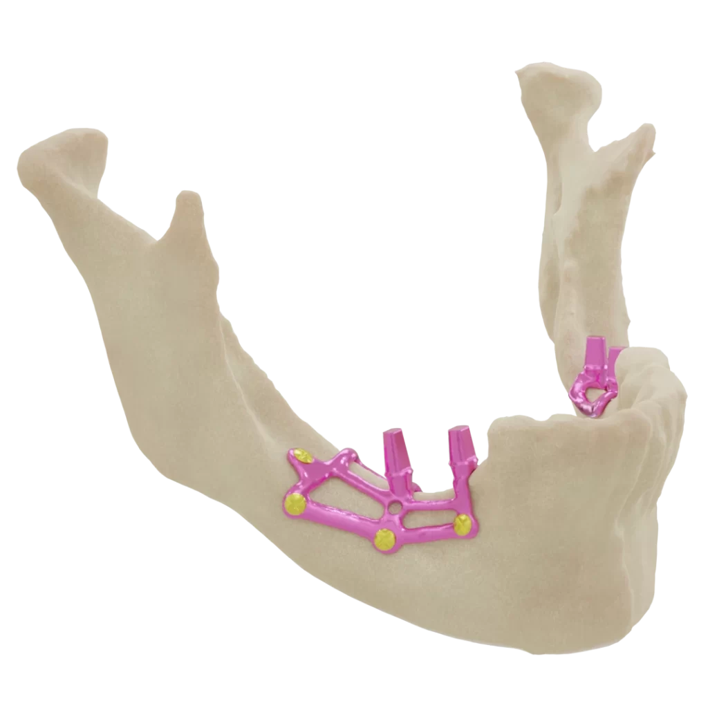 Subperiosteal Implant for Partial edentulous mandible