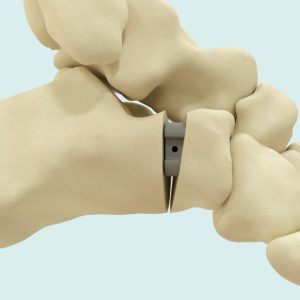 Evans osteotomy wedge is used to correct flatfoot deformities